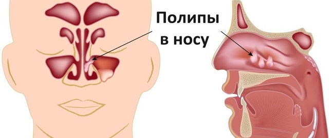 Наріст на носі у людини види і способи лікування