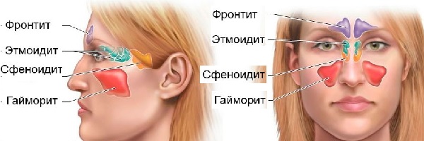 Народні засоби на допомогу від гаймориту