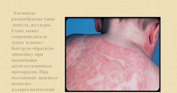 Народні методи лікування алергії