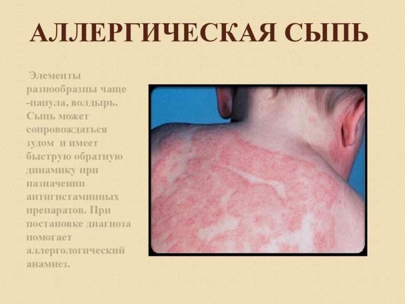 Народні методи лікування алергії