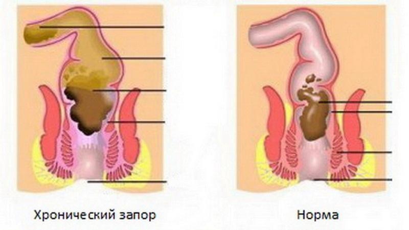 Народні проносні засоби від запору швидкого дії