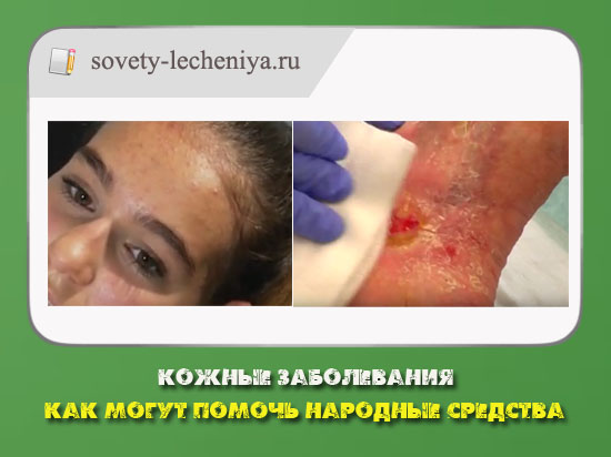 Народні рецепти при захворюваннях шкіри