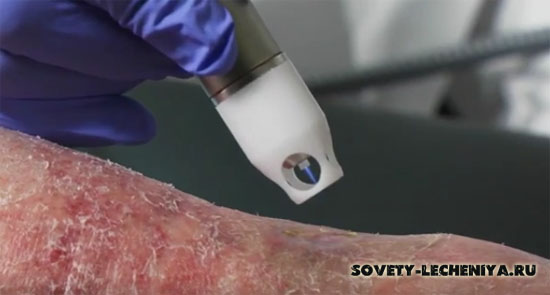 Народні рецепти при захворюваннях шкіри