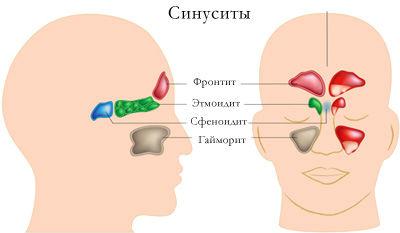 Народні способи лікування синуситу