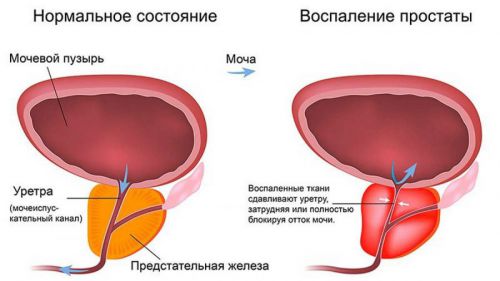 Народні засоби лікування аденоми простати у чоловіків