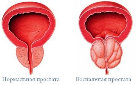 Народні засоби лікування аденоми простати у чоловіків