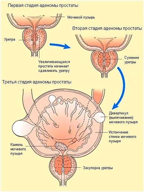 Народні засоби лікування аденоми простати у чоловіків