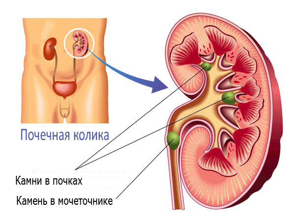 Народні засоби при нирковій коліці