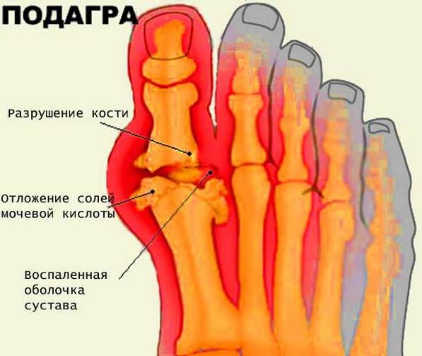 Народні засоби при подагрі на ногах Суглоби