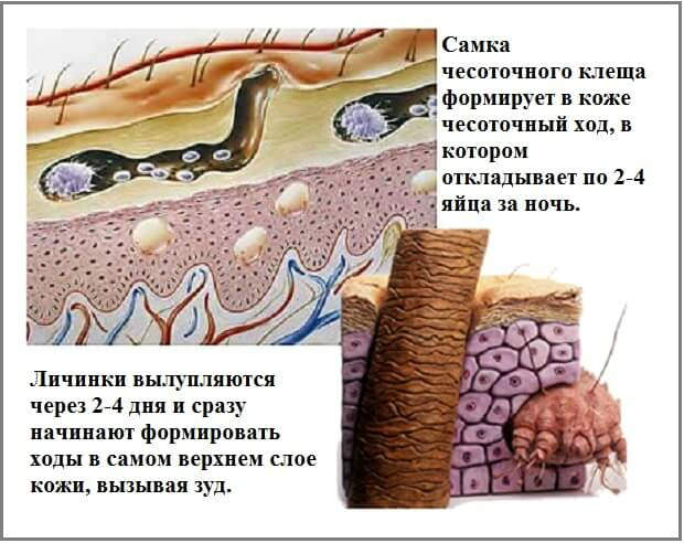 Народні засоби від корости у людини