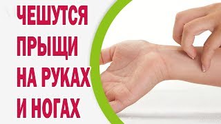 Народні засоби від корости у людини