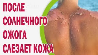 Народні засоби від корости у людини