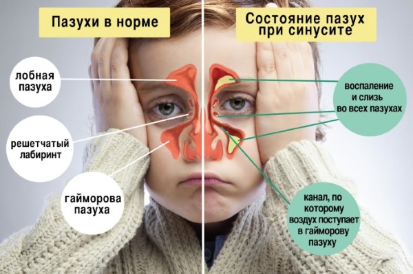 Народні засоби від нежитю і закладеності носа для дітей 1-3, 4-6, 7-10 років, Чим лікувати дитину