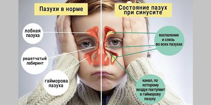 Народні засоби від нежитю і закладеності носа для дітей