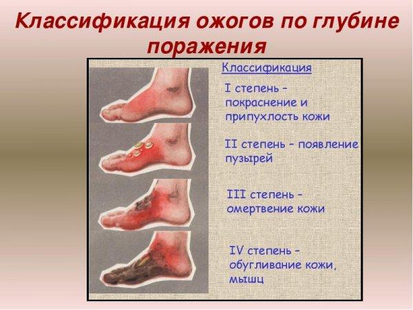 Народні засоби від опіків з пухирями