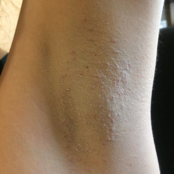 Народні засоби від пітливості ніг: лікування народними методами поту ніг Народні засоби від пітливості ніг: лікування народними методами поту ніг