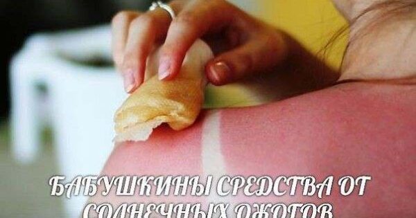 Народні засоби від сонячних опіків