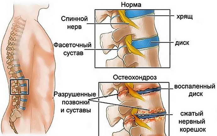 Народні засоби від судом у ногах