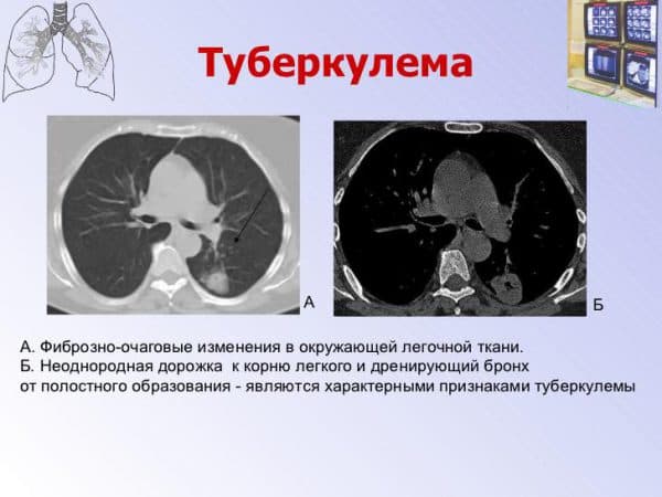 Народні засоби від туберкульозу легенів у дорослих Народні засоби від туберкульозу легенів у дорослих