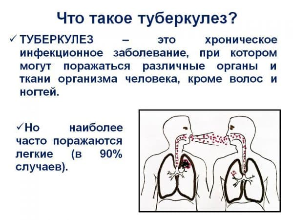 Народні засоби від туберкульозу легенів у дорослих Народні засоби від туберкульозу легенів у дорослих