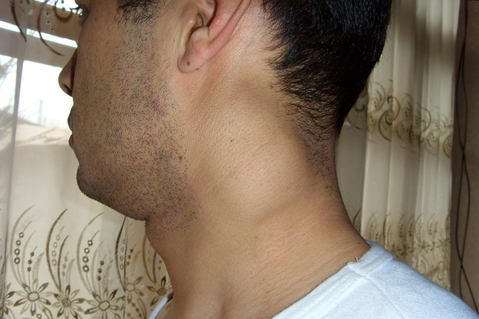 Народні засоби від туберкульозу легенів у дорослих Народні засоби від туберкульозу легенів у дорослих