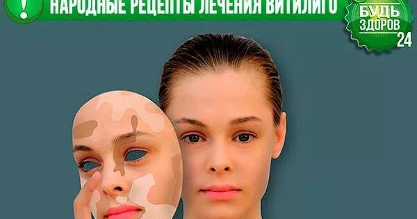 Народні засоби від вітіліго. Найбільш ефективні народні засоби від вітіліго