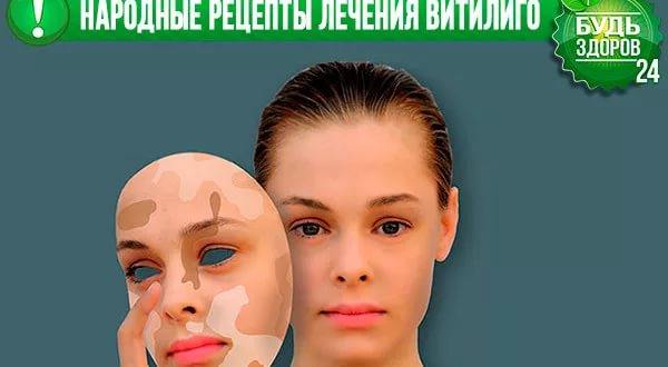 Народні засоби від вітіліго. Найбільш ефективні народні засоби від вітіліго