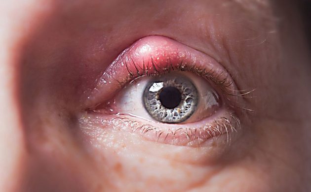 Народні засоби від ячменю на оці у дорослого