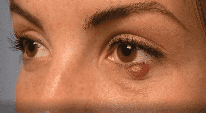 Народні засоби від ячменю на оці у дорослого