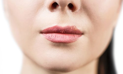 Народні засоби від застуди на губах швидко Народні засоби від застуди на губах швидко