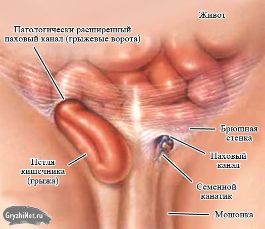 Народне лікування пахової грижі у чоловіків