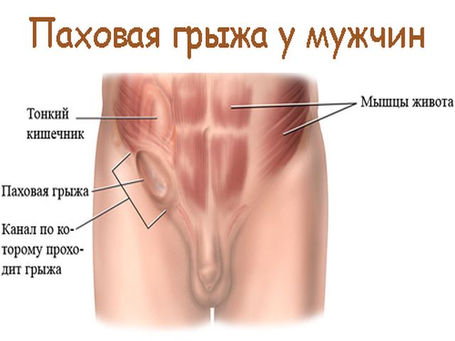 Народне лікування пахової грижі у чоловіків