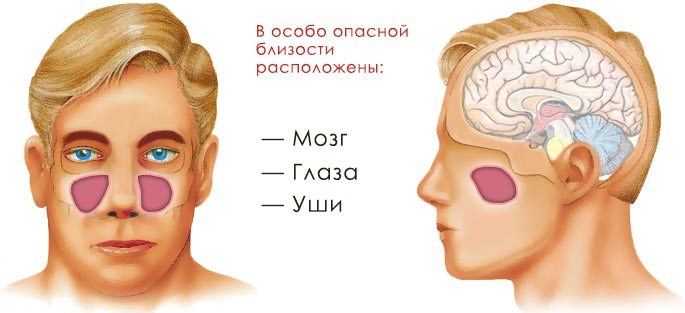 Наслідки та ускладнення, або що буде, якщо не лікувати гайморит? Наслідки запущеного гаймориту у дорослих і дітей
