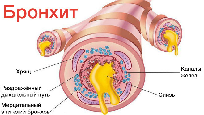 Наслідки ускладнення гаймориту