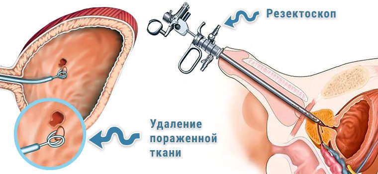 Наслідки видалення сечового міхура – як жити далі?