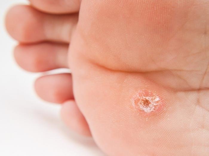 Натоптиші на підошві зі стрижнем лікування народними засобами