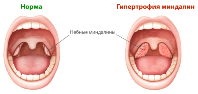 Навіщо потрібні гланди людині можливі захворювання лікування і процедура видалення