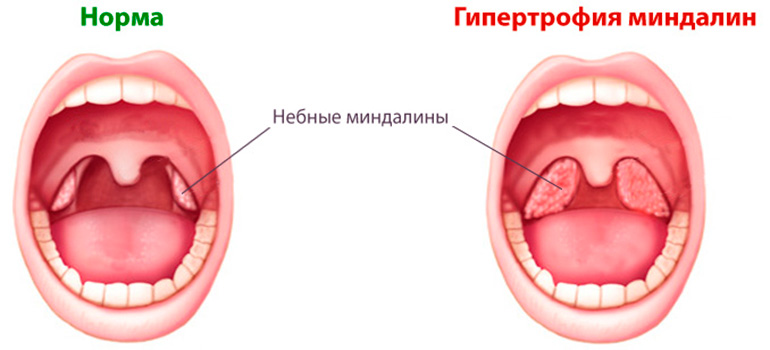 Навіщо потрібні гланди людині можливі захворювання лікування і процедура видалення