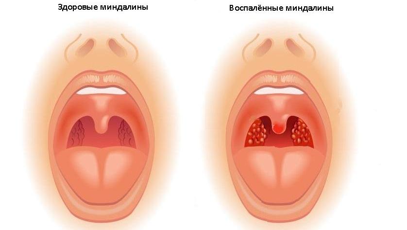 Навіщо потрібні гланди людині можливі захворювання лікування і процедура видалення