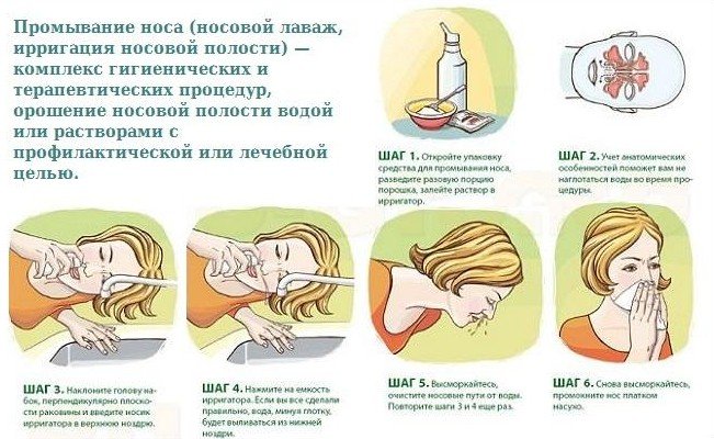 Навіщо промивати ніс солоною водою при нежиті. Промивання носа солоною водою: навіщо, коли і як проводити процедуру. Як промити ніс дитині правильно сольовим розчином