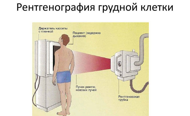 Навіщо робити рентген грудної клітки