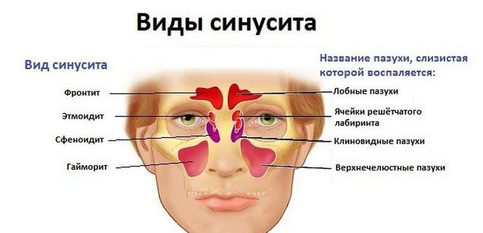 Найбільш ефективні антибіотики для лікування синуситу