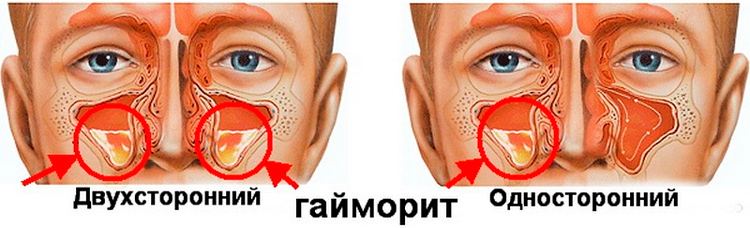 Найбільш ефективні народні засоби від гаймориту