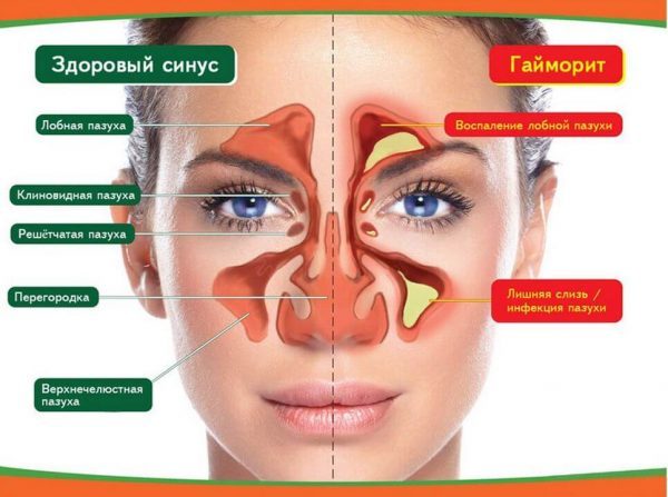 найефективніші препарати для лікування гаймориту