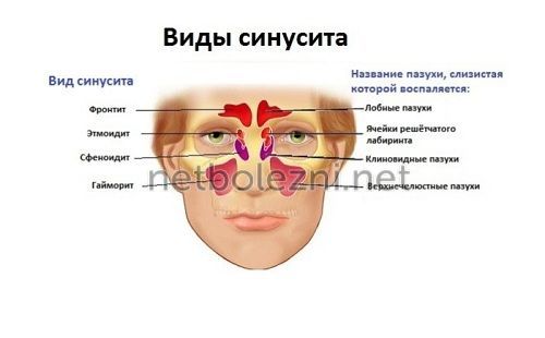 найефективніші способи лікування гаймориту народними засобами
