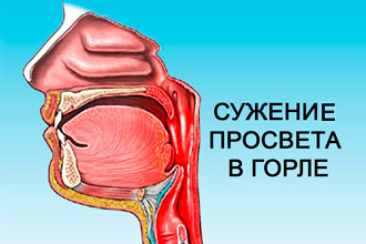 найефективніші способи зняти набряк горла. Набряк горла при ангіні – Що робити?