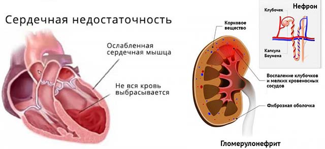 найефективніші способи зняти набряк горла. Набряк гортані: які симптоми і лікування