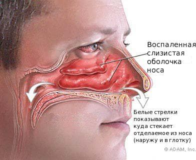 Назофарингіт симптоми і лікування