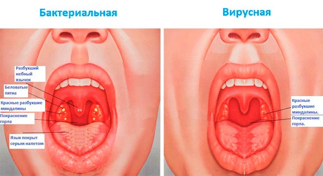 Небезпечний пронос і кашель у дитини без температури — що потрібно знати батькам? Що робити, якщо у дитини одночасно пронос, нежить, температура і кашель
