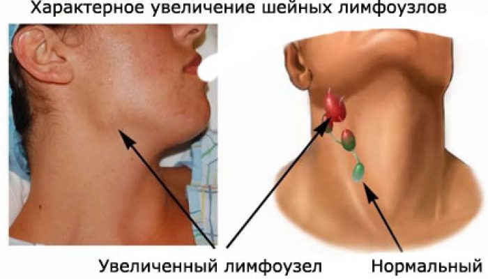 Новоутворення на шиї: лікування пухлин шиї. Симптоми, ознаки, діагностика і лікування раку шиї
